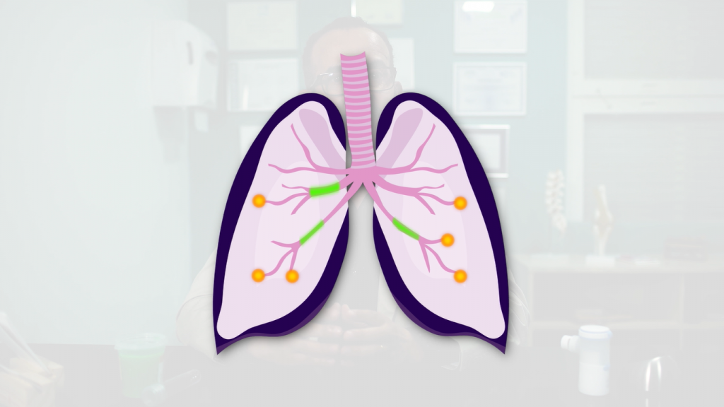 Inalação e Fisioterapia Respiratória na Fibrose Cística